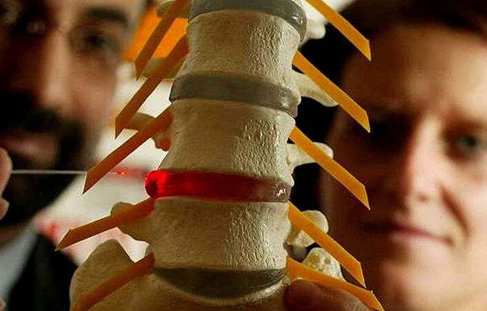 İntervertebral disklerin bütünlüğündeki değişiklikler