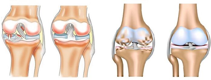 Eklemlerin artriti (solda) ve artrozu (sağda) arasındaki fark