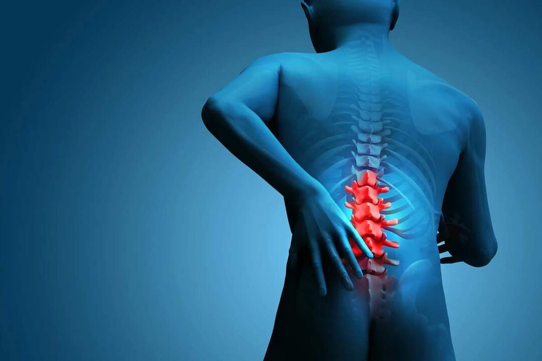 Lomber omurganın osteokondrozunun ana semptomu bel ağrısıdır. 