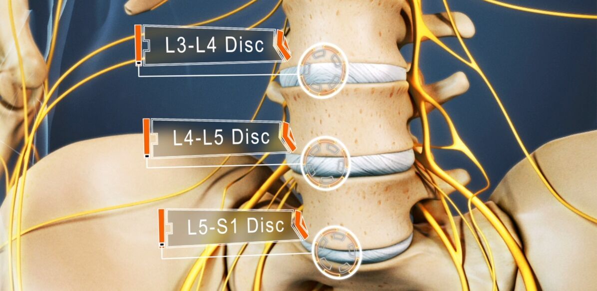Osteokondrozda en sık etkilenen lomber omurganın diskleri
