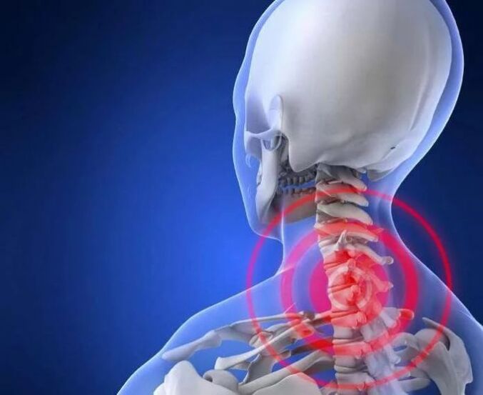 Osteokondroz nedir