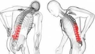 İntervertebral fıtık - osteokondroz ile komplikasyon