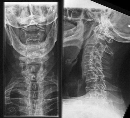 Servikal X -Ray - Osteokondroz Teşhisi Yöntemi