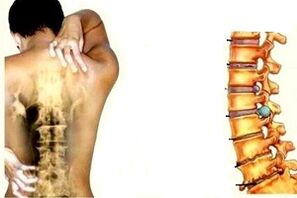 Servikal osteokondroz gelişiminin farklı aşamalarında sırt ağrısı