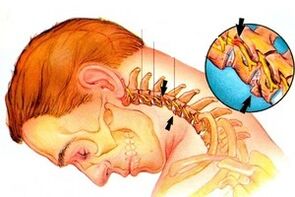 Servikal osteokondroz ile omurgadaki sinirin sıkıştırılması