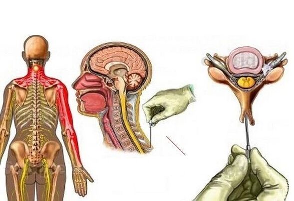 Akupunktur ile servikal osteokondroz tedavisi