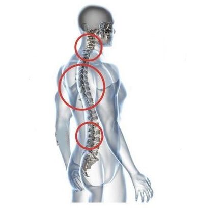 Spinal osteokondroz bölgeleri